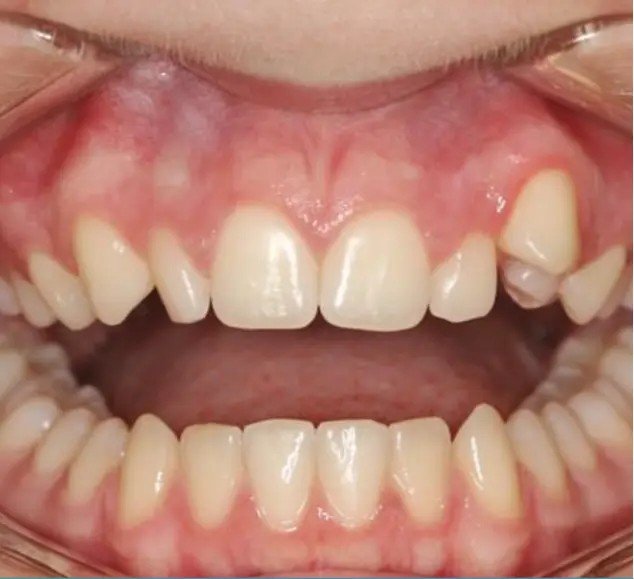 Before — crowded teeth correction with Invisalign