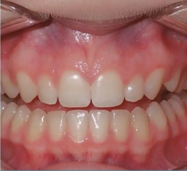 After — straight aligned smile with Invisalign