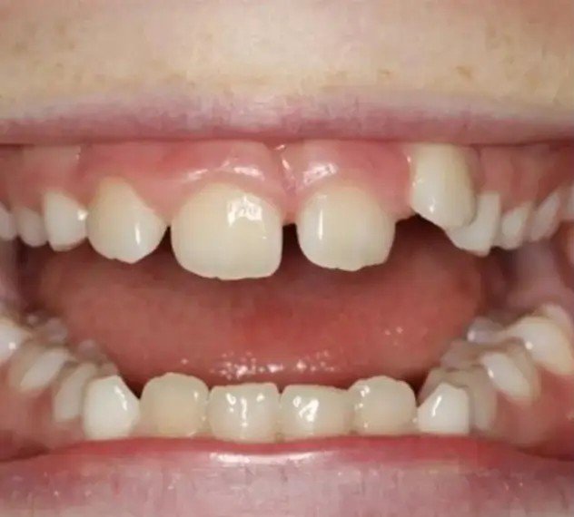 Before — gap closure with Invisalign