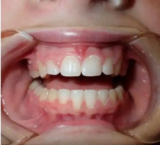 After — gap closed beautifully aligned smile