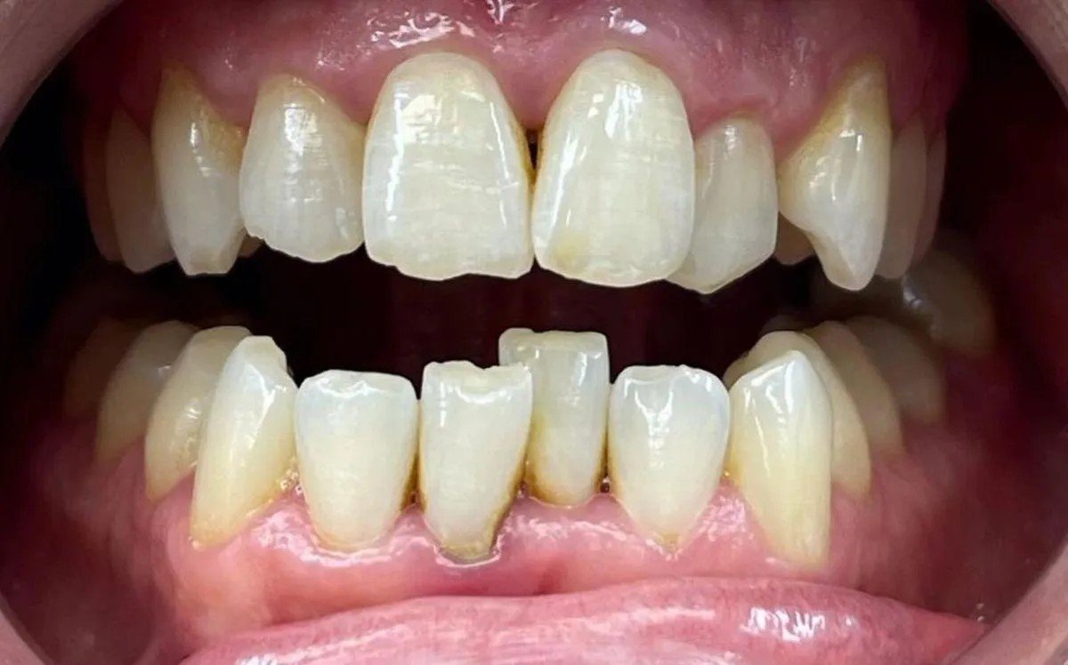 Before — bite correction with Invisalign