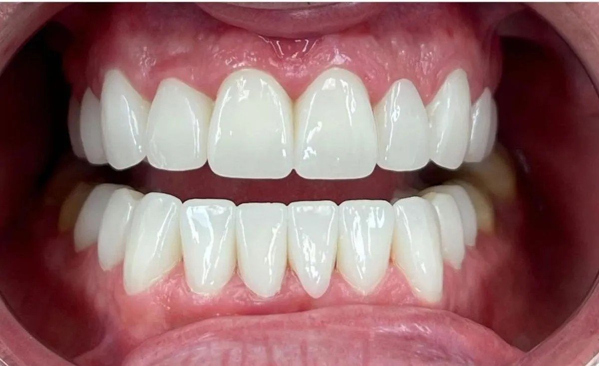 After — complete smile makeover with Invisalign